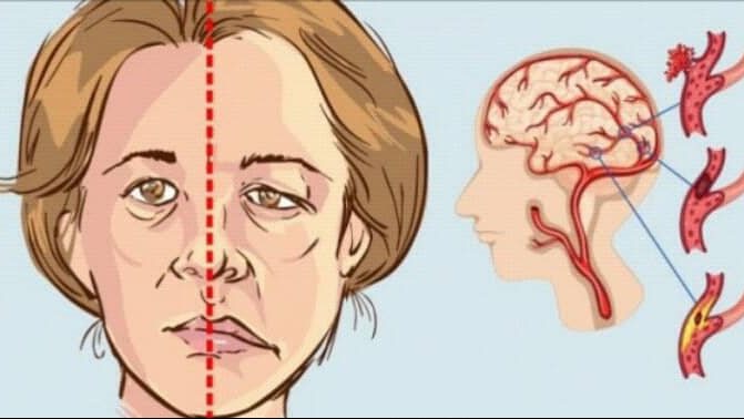 صورة 5 علامات بسيطة تدل على إصابة الشخص بالسكتة الدماغية